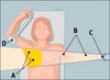 radiation_treatment1[2]